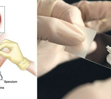 تست غربالگری سرطان