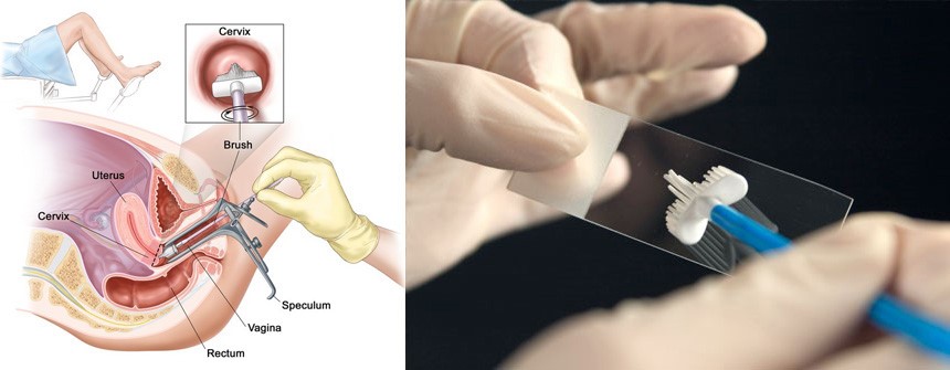 تست غربالگری سرطان